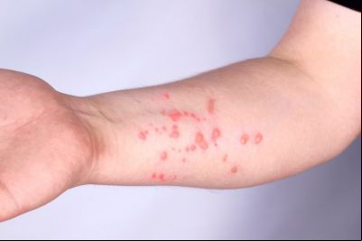 notícia: Mpox: Saiba quais os sintomas, como se prevenir e onde procurar atendimento em Ananindeua